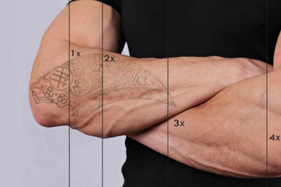 Factors That Influence a Successful Tattoo Removal Treatment in Brisbane, QLD
