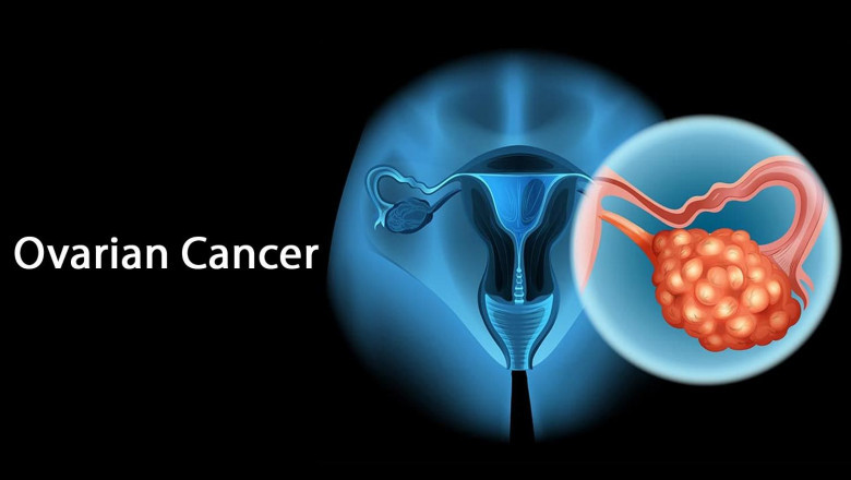 Ovarian Cancer Drugs Market Overview, Analysis and Trends during Forecast period 2022-2028
