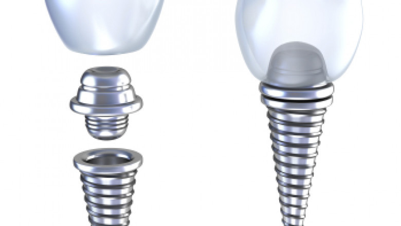 What Are Mouthguards? Why Do We Need Them?