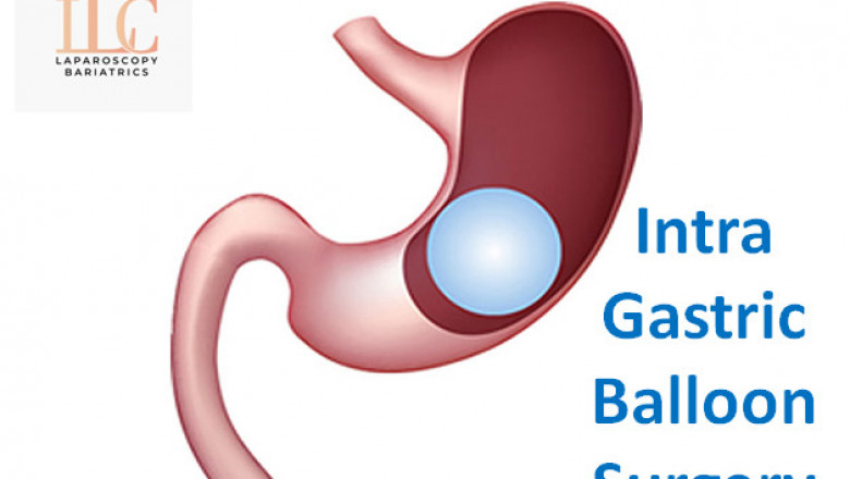 Intra Gastric Balloon | Laser Bariatric Surgery | Dr. Achal Agarwal