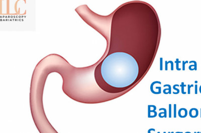 Intra Gastric Balloon | Laser Bariatric Surgery | Dr. Achal Agarwal