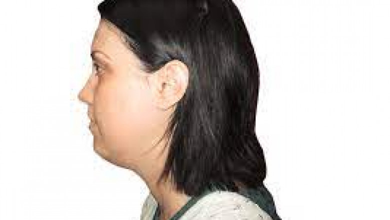 Is it possible to liposuction the neck?