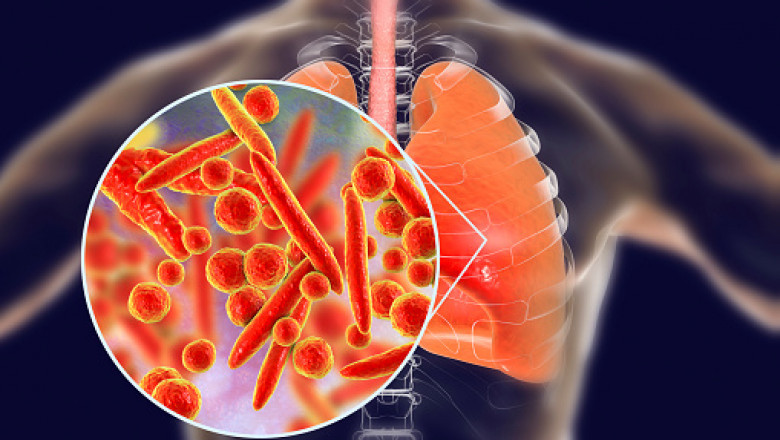 Blood tests can be used to confirm or identify infection in order to diagnose pneumonia