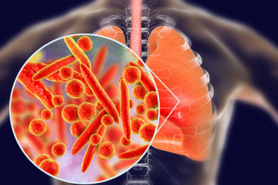 Blood tests can be used to confirm or identify infection in order to diagnose pneumonia