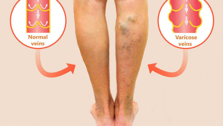 Should You Treat Varicose Veins Early?