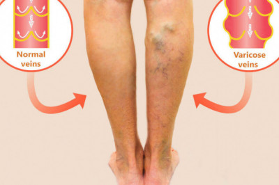 Should You Treat Varicose Veins Early?