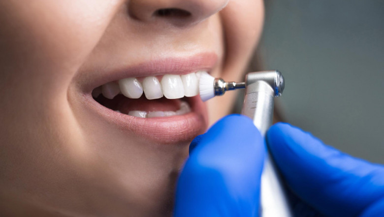 How Do I Know I Need Veneers?
