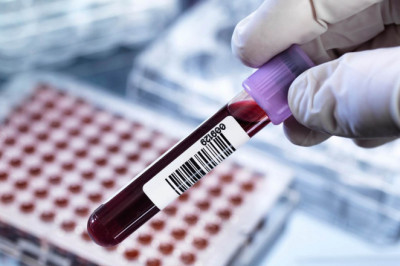 Cancer Biomarkers Tested Using Body Tissue Samples, Blood Samples, Or Other Physiological Fluids
