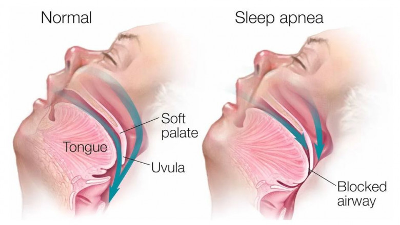 Causes of sleep apnea