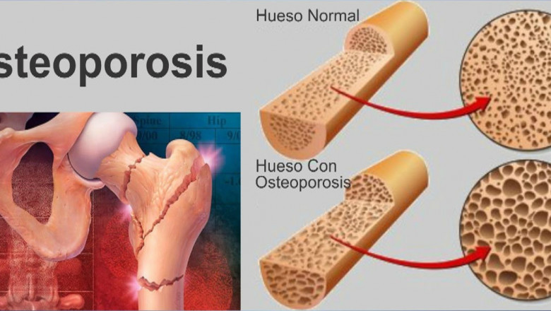 Osteoporosis Drugs Market Growth Insights and Forecast Analysis, 2020-2027