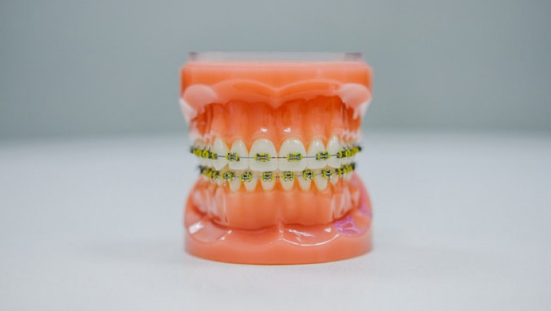 How Long Do Invisalign Treatments Last?