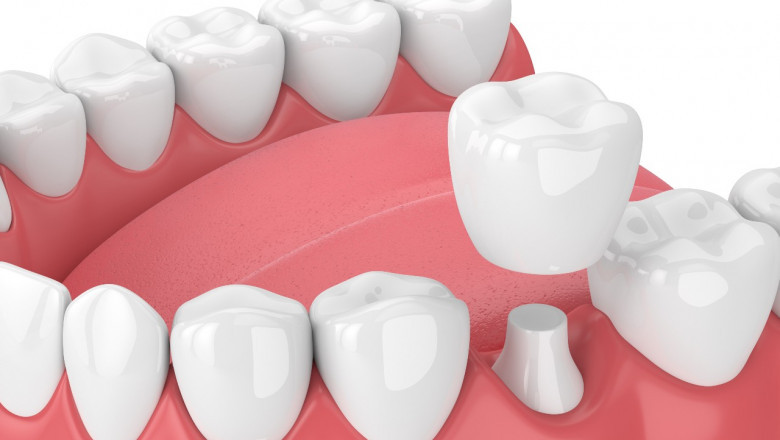 Important Information About Effective Root Canal Treatment