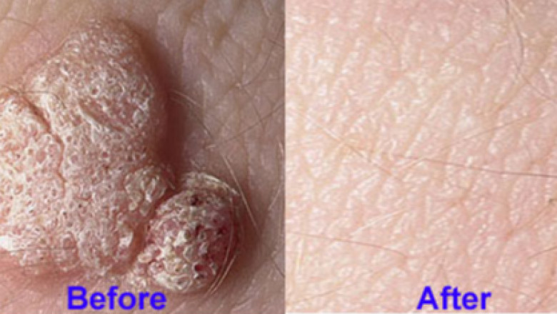Why choose HPV warts removal treatment in Malaysia?