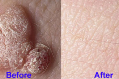 Why choose HPV warts removal treatment in Malaysia?