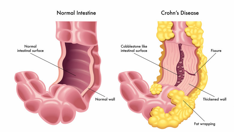 All you need to Know about Crohn's Disease Treatment