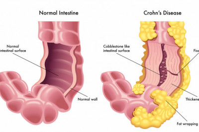 All you need to Know about Crohn's Disease Treatment