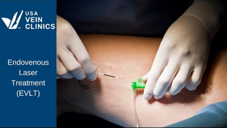 Endovenous Laser Treatment (EVLT)