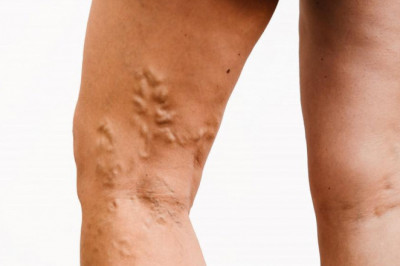 Varicose Veins - What More Do You Need To Know?