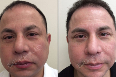 Find The Best Hair Transplant Doctor in New Jersey Online