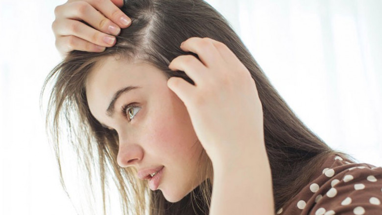 What is telogen effluvium?