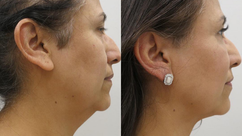 What is eye lift surgery?