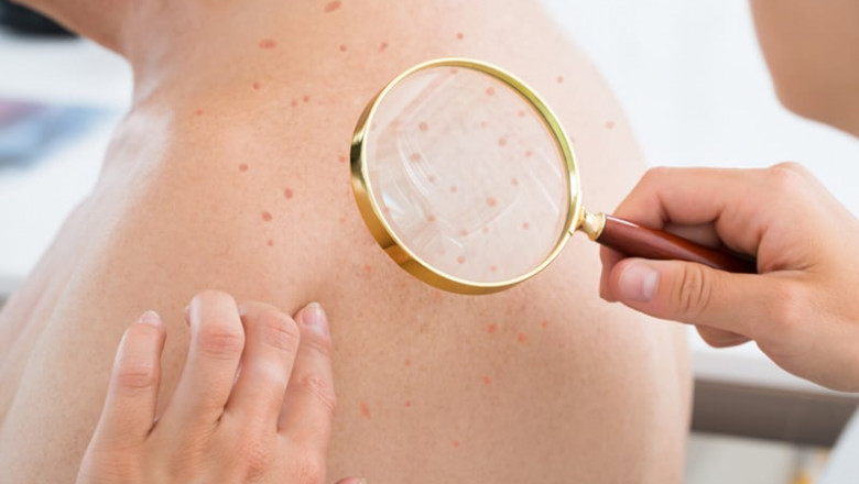 Actinic Keratosis Refers To The Development Of A Scaly Surface On Skin Caused By Prolonged Sun Exposure.