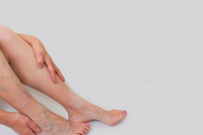 Are Spider Veins a Health Concern?