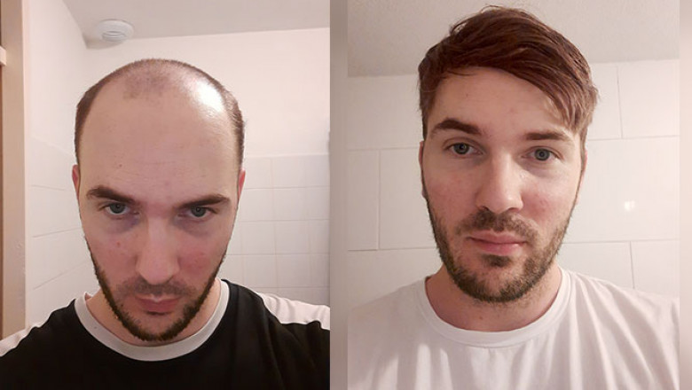 Breaking Down Common Myths Behind Nonsurgical Hair Loss Solutions