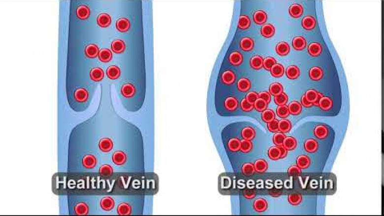 What Healthy Veins Vs. Diseased Veins Look Like
