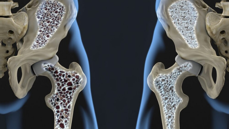 Can Osteoporosis Drugs hurt your bones?