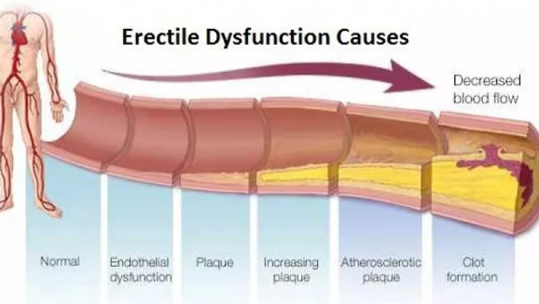 Must-know reasons to choose extracorporeal shockwave therapy for Erectile Dysfunction in Kuala Lumpur