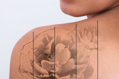 Tattoo Removal Lasers: The Most Effective Ways to Erase Your Ink
