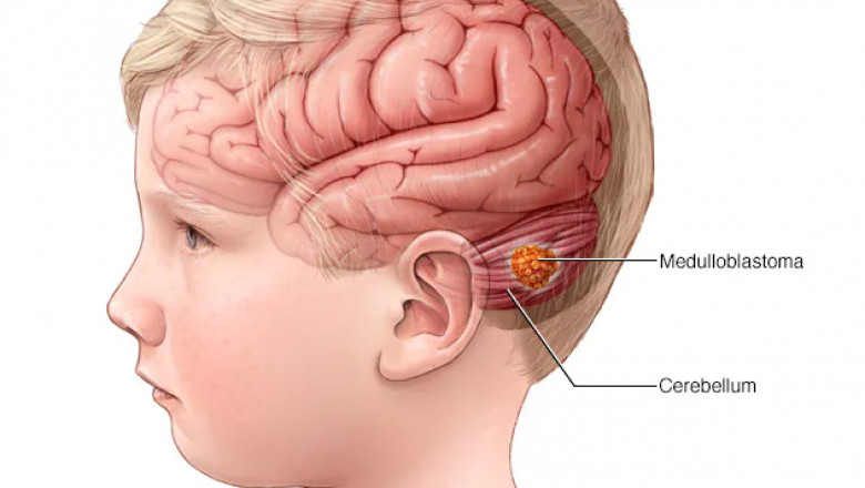 Glioblastoma Multiforme Treatment Market growth & size, future innovations & forecast by 2028