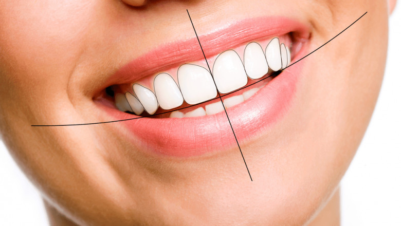Root canal dentist in borivali