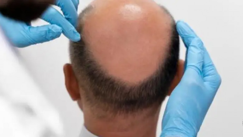 Best Hair Loss Treatment Price | AHS UAE