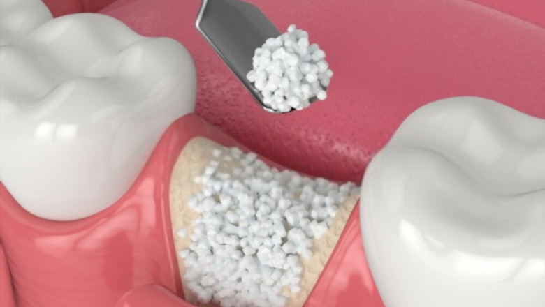 Dental Bone Grafts - What They Are and Why We Need Them