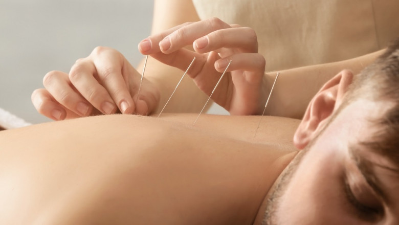 Should You Consider Acupuncture To Improve Your Health And Wellbeing?