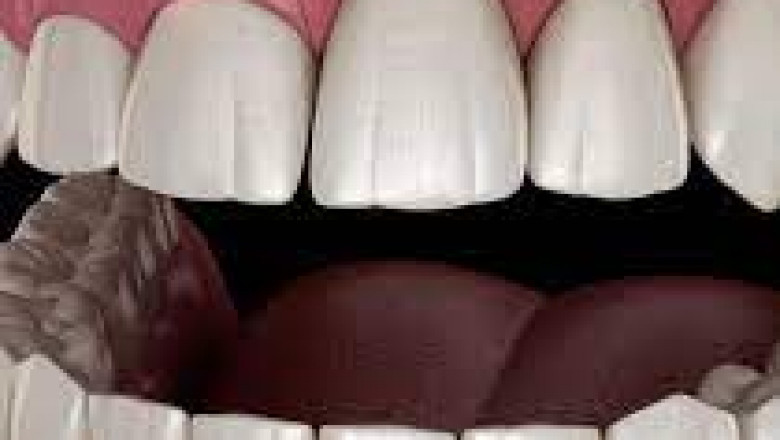 What Is The Use Of Laser In Gingivectomy?