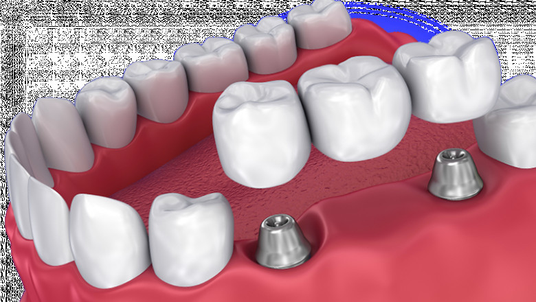 Best bridges in Gladstone