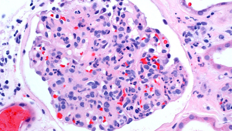Eosinophilic Esophagitis Is A Chronic Esophageal Immune System Disease.