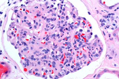 Eosinophilic Esophagitis Is A Chronic Esophageal Immune System Disease.