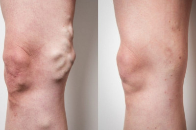How Much Is the Treatment for Varicose Veins?