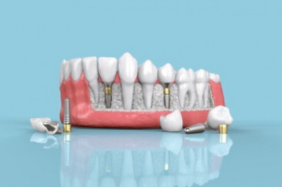 What to Expect During Dental Implant Treatment?