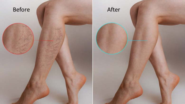 Can You Explain The Major Causes Or Reasons For Varicose Veins?