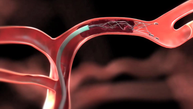 Thrombectomy Devices Market Size Analysis, Revenue Forecasts and Regional Focus