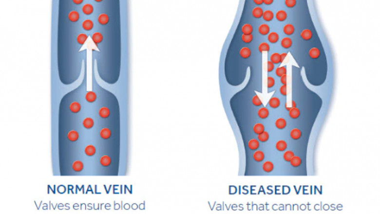 Varicose Vein