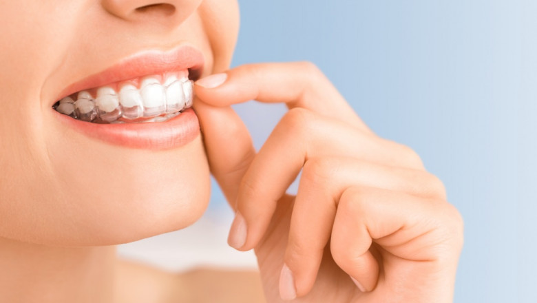 Everything You Need To Know About Invisalign – Tower House Dental Clinic