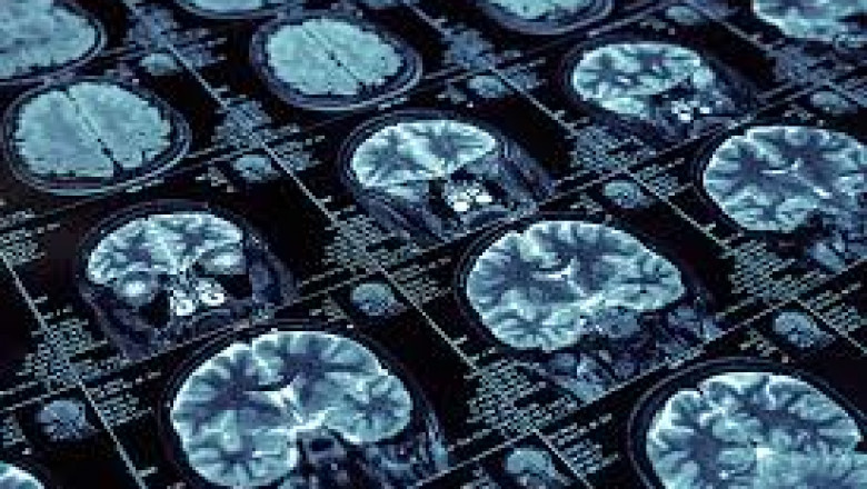 Understanding The Difference Between Neurosurgery & Neurology