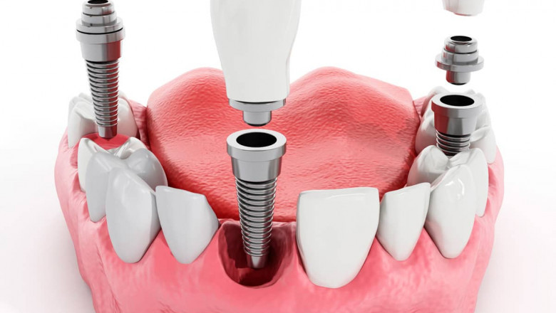 Solutions for missing teeth