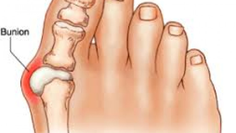 What is Bunion? Symptoms, Causes & Prevention